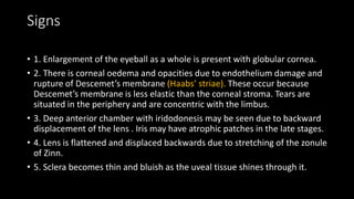Signs
• 1. Enlargement of the eyeball as a whole is present with globular cornea.
• 2. There is corneal oedema and opacities due to endothelium damage and
rupture of Descemet’s membrane (Haabs’ striae). These occur because
Descemet’s membrane is less elastic than the corneal stroma. Tears are
situated in the periphery and are concentric with the limbus.
• 3. Deep anterior chamber with iridodonesis may be seen due to backward
displacement of the lens . Iris may have atrophic patches in the late stages.
• 4. Lens is flattened and displaced backwards due to stretching of the zonule
of Zinn.
• 5. Sclera becomes thin and bluish as the uveal tissue shines through it.
 