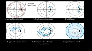 1. Baring of the blind spot 2. Small scotomatous areas 3. Seidel’s sign
4. Bjerrum’s arcuate scotoma 5. Double arcuate scotoma or 6. Temporal-central island
annular scotoma
 
