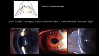 Convex Iris Lens Diaphragm | Shallow anterior chamber | Narrow entrance to chamber angle
Small and hypermetropic eye
 