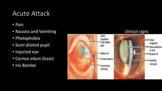 Acute Attack
• Pain
• Nausea and Vomiting clinical signs
• Photophobia
• Semi dilated pupil
• Injected eye
• Cornea edam (haze)
• Iris Bombé
 