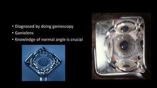 • Diagnosed by doing gonioscopy
• Goniolens
• Knowledge of normal angle is crucial
 