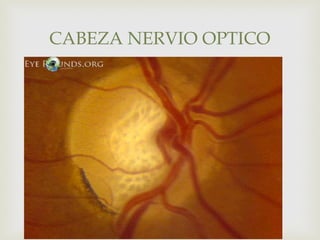 
 FOTO LAMINA CRIBOSA
CABEZA NERVIO OPTICO
 