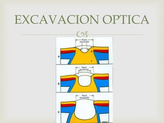 
EXCAVACION OPTICA
 