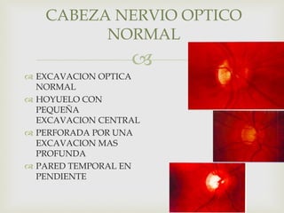 
 EXCAVACION OPTICA
NORMAL
 HOYUELO CON
PEQUEÑA
EXCAVACION CENTRAL
 PERFORADA POR UNA
EXCAVACION MAS
PROFUNDA
 PARED TEMPORAL EN
PENDIENTE
CABEZA NERVIO OPTICO
NORMAL
 