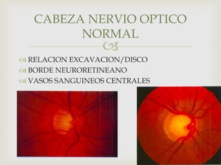 
 RELACION EXCAVACION/DISCO
 BORDE NEURORETINEANO
 VASOS SANGUINEOS CENTRALES
CABEZA NERVIO OPTICO
NORMAL
 