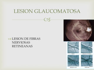 
 LESION DE FIBRAS
NERVIOSAS
RETINEANAS
LESION GLAUCOMATOSA
 