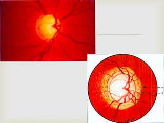 
 FIG 9.38 Y FIG 9.39
 