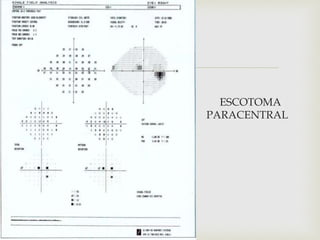 
 ESCOTOMA
PARACETRAL PARACENTRAL

PERI
 