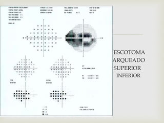 
 ESCOTOMA
 ARQUEADO
 SUPERIOR
 INFERIOR
PERIMETR
 