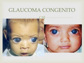
 FOTO
GLAUCOMA CONGENITO
 