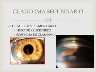 
 GLAUCOMA PIGMENTARIO
 HUSO DE KRUKENBERG
 SOSPECHA DE GLAUCOMA
GLAUCOMA SECUNDARIO
 