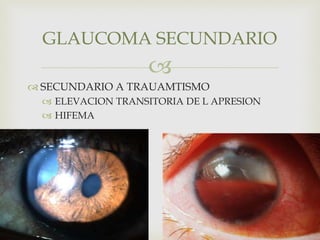 
 SECUNDARIO A TRAUAMTISMO
 ELEVACION TRANSITORIA DE L APRESION
 HIFEMA
GLAUCOMA SECUNDARIO
 