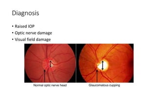 Glaucoma.pptx
