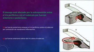 El drenaje está afectado por la sobreposición entre
el iris periférico y en el trabéculo por fuerzas
anteriores o posteriores:
A) Las fuerzas posteriores empujan al iris periférico contra el trabéculo
por contracción de membranas inflamatorias.
B) Las fuerzas anteriores estiran del iris sobre el trabéculo.
 