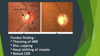 GLAUCOMA -disease ,symptoms, sign, types ,management.pptx