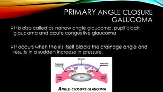 PRIMARY ANGLE CLOSURE
GALUCOMA
➢It is also called as narrow angle glaucoma, pupil block
glaucoma and acute congestive glaucoma
➢It occurs when the iris itself blocks the drainage angle and
results in a sudden increase in pressure.
 