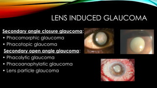 LENS INDUCED GLAUCOMA
Secondary angle closure glaucoma:
• Phacomorphic glaucoma
• Phacotopic glaucoma
Secondary open angle glaucoma:
• Phacolytic glaucoma
• Phacoanaphylatic glaucoma
• Lens particle glaucoma
 
