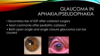 GLAUCOMA IN
APHAKIA/PSEUDOPHAKIA
• Secondary rise of IOP after cataract surgery
• Most commonly after pediatric cataract
• Both open angle and angle closure glaucoma can be
caused
 