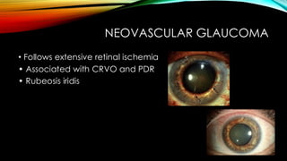 NEOVASCULAR GLAUCOMA
• Follows extensive retinal ischemia
• Associated with CRVO and PDR
• Rubeosis iridis
 