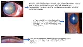 glaucoma EXPOSICION DE MEDICINA HUMANA.pptx