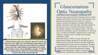 Glaucomatous
Optic Neuropathy
A, Glaucomatous optic nerve (anterior optic nerve head and
transverse view, right eye). Note thinning, undermining, and
focal notching (FN) of inferior neuroretinal rim; enlarged
central cup with visible laminar fenestrations (LF); nasal
shift of retinal vessels; and peripapillary atrophy. B, Clinical
view of glaucomatous optic nerve head demonstrating
extensive loss of the neuroretinal rim.
Glaucomatous optic neuropathy is the hallmark of all
glaucoma types, characterized by progressive loss of retinal
ganglion cells (RGCs) and their axons. Histologically, early
glaucomatous damage involves axonal loss, vascular
changes, and glial cell depletion, primarily affecting the
superior and inferior optic disc poles. Structural changes in
the optic nerve may occur before functional vision loss.
The damage originates at the lamina cribrosa, with tissue
destruction extending to central visual pathways in advanced
cases. In infants and children, cupping involves scleral ring
expansion, making it more reversible with treatment
compared to adults.
Intraocular pressure (IOP) is a major risk factor for
glaucomatous damage, though up to one-third of cases in
North America occur with normal or low IOP. Additional
contributing factors include axonal compression, disrupted
axoplasmic flow, impaired optic nerve perfusion, vascular
dysregulation, and systemic hemodynamic changes.
Potential neurodegenerative triggers include glutamate
excitotoxicity, autoimmunity, and neurotrophic deprivation.
 