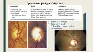 Ophthalmoscopic Signs of Glaucoma
• Retinal NFL change
• Optic nerve head
• Peripapillary change:Alpha
and beta zone
 