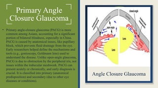 Primary Angle
Closure Glaucoma
• Primary angle-closure glaucoma (PACG) is more
common among Asians, accounting for a significant
portion of bilateral blindness, especially in China.
PACG is caused by anatomical issues, like pupillary
block, which prevents fluid drainage from the eye.
Early researchers helped define the mechanisms and
tools (e.g., gonioscopy, Goldmann lens) used to
understand the disease. Unlike open-angle glaucoma,
PACG is due to obstruction by the peripheral iris, not
issues within the trabecular meshwork. PACG can
present acutely or chronically, and early diagnosis is
crucial. It is classified into primary (anatomical
predisposition) and secondary (due to other eye
diseases or conditions).
Angle Closure Glaucoma
 
