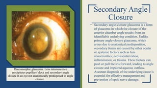 Secondary Angle
Closure
• Secondary angle-closure glaucoma is a form
of glaucoma in which the closure of the
anterior chamber angle results from an
identifiable underlying condition. Unlike
primary angle-closure glaucoma, which
arises due to anatomical predisposition,
secondary forms are caused by other ocular
or systemic factors such as lens
abnormalities, neovascularization,
inflammation, or trauma. These factors can
push or pull the iris forward, leading to angle
closure and impaired aqueous outflow.
Accurate diagnosis of the underlying cause is
essential for effective management and
prevention of optic nerve damage.
Phacomorphic glaucoma. Lens intumescence
precipitates pupillary block and secondary angle
closure in an eye not anatomically predisposed to angle
closure.
 