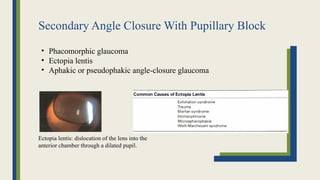 Secondary Angle Closure With Pupillary Block
• Phacomorphic glaucoma
• Ectopia lentis
• Aphakic or pseudophakic angle-closure glaucoma
Ectopia lentis: dislocation of the lens into the
anterior chamber through a dilated pupil.
 