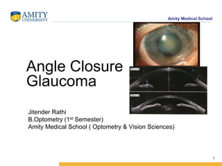 Amity Medical School
Angle Closure
Glaucoma
1
Jitender Rathi
B.Optometry (1st Semester)
Amity Medical School ( Optometry & Vision Sciences)
 