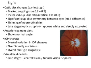 Signs
• Optic disc changes (earliest sign)
• Marked cupping (size 0.7 – 0.9)
• Increased cup–disc ratio (vertical C:D >0.6)
• Significant cup–disc asymmetry between eyes (>0.2 difference)
• Thinning of neuroretinal rim
• Late stages(optic atrophy) - appears white and deeply excavated
• Anterior segment signs
• Shows normal angle
• IOP changes
• Diurnal variation in IOP changes
• Over 5mmHg suspicious
• Over 8 mmHg is diagnostic
• Visual field defects
• Late stages – central vision / tubular vision is spared
 