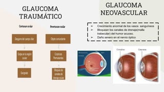GLAUCOMA
TRAUMÁTICO
➢ Crecimiento anormal de los vasos sanguíneos
➢ Bloquean los canales de drenaje(malla
trabecular) del humor acuoso.
➢ Daño severo en el nervio óptico
GLAUCOMA
NEOVASCULAR
 