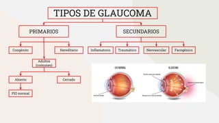 TIPOS DE GLAUCOMA
PRIMARIOS SECUNDARIOS
Congénito Hereditario
Adultos
(comunes)
Abierto Cerrado
Facogénico
Neovascular
Traumático
Inﬂamatorio
PIO normal
 