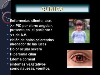 CLÍNICA
   Enfermedad silente, asn.
   >> PIO por cierre angular,
    presenta en el paciente :
   << de A.V.
   visión de halos coloreados
    alrededor de las luces
   Dolor ocular severo
   Hiperemia ciliar
   Edema corneal
   síntomas Vegetativos
    como nauseas, vómitos,
 
