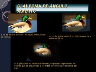 GLAUCOMA DE ÁNGULO
                 ABIERTO




1 no da lugar a síntoma. No causa dolor ,visión
es normal.                                         no recibe tratamiento,1 en deteriorarse es la
                                                   vsión periférica




              Si el glaucoma no recibe tratamiento, se pueden dejar de ver los
              objetos que se encuentran a los lados o se miran por el rabillo del
              ojo.
 