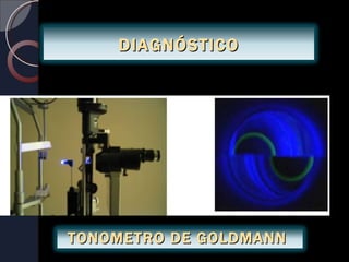 DIAGNÓSTICO




TONOMETRO DE GOLDMANN
 