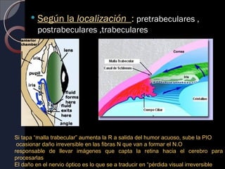    Según la localización : pretrabeculares ,
          postrabeculares ,trabeculares




Si tapa “malla trabecular” aumenta la R a salida del humor acuoso, sube la PIO
 ocasionar daño irreversible en las fibras N que van a formar el N.O
responsable de llevar imágenes que capta la retina hacia el cerebro para
procesarlas
El daño en el nervio óptico es lo que se a traducir en “pérdida visual irreversible
 