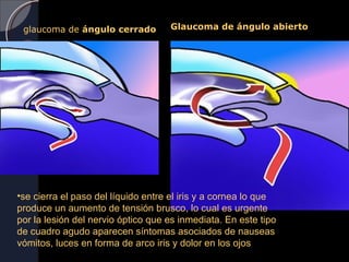 glaucoma de ángulo cerrado         Glaucoma de ángulo abierto




•se cierra el paso del líquido entre el iris y a cornea lo que
produce un aumento de tensión brusco, lo cual es urgente
por la lesión del nervio óptico que es inmediata. En este tipo
de cuadro agudo aparecen síntomas asociados de nauseas
vómitos, luces en forma de arco iris y dolor en los ojos
 