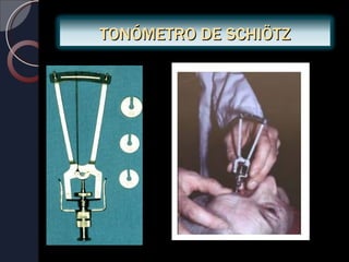 TONÓMETRO DE SCHIÖTZ
 