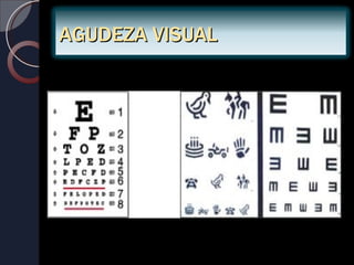 AGUDEZA VISUAL
 