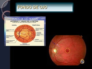 FONDO DE OJO
 