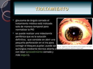 TRATAMIENTO

 glaucoma de ángulo cerrado el
  tratamiento médico está indicado
  solo de manera temporal para
  normalizar la PIO
 se puede realizar una iridectomía
  periférica que es la solución
  definitiva, que consiste en abrir una
  pequeña perforación en el iris para
  corregir el bloqueo pupilar; puede ser
  quirúrgica mediante técnica abierta o
  con láser (procedimiento cerrado y
  más seguro).
 