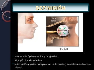 DEFINICIÓN




 neuropatía óptica crónica y progresiva
 Con pérdida de la retina
 excavación y palidez progresivas de la papila y defectos en el campo
  visual.
 