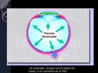 Va asociado, aunque no en todos los
casos, a un aumento de la PIO.
 