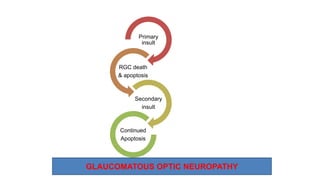 Primary
insult
RGC death
& apoptosis
Secondary
insult
Continued
Apoptosis
GLAUCOMATOUS OPTIC NEUROPATHY
 