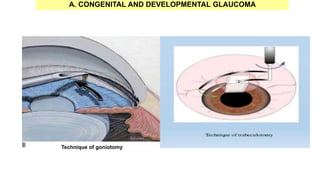 Technique of goniotomy
A. CONGENITAL AND DEVELOPMENTAL GLAUCOMA
 