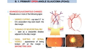 • MARKED CUPPING - cup size 0.7 to
0.9, excavation may even reach the
discmargin
• THINNINGOFNEURORETINALRIM
- seen as a crescentric shadow
adjacent to thediscmargin
• NASAL SHIFTING OF RETINAL
VESSELS - appearance of being
broken off at the margin –
BAYONETTINGSIGN
2. ADVANCEDGLAUCOMATOUS CHANGES
Revealsoneor moreof the followingsigns:
NORMAL LATECHANGE
B. 1. PRIMARY OPEN-ANGLE GLAUCOMA (POAG)
 