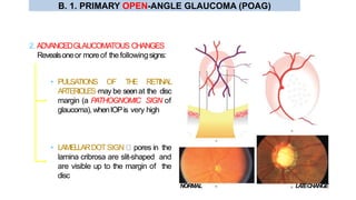 • PULSATIONS OF THE RETINAL
ARTERIOLES-may be seenat the disc
margin (a PATHOGNOMIC SIGN of
glaucoma), whenIOPis very high
• LAMELLARDOTSIGN pores in the
lamina cribrosa are slit-shaped and
are visible up to the margin of the
disc
2. ADVANCEDGLAUCOMATOUS CHANGES
Revealsoneor moreof the followingsigns:
NORMAL LATECHANGE
B. 1. PRIMARY OPEN-ANGLE GLAUCOMA (POAG)
 