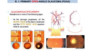 • As the damage progresses, all the
NEURALTISSUEof the discis destroyed
and the OPTIC NERVE HEAD appears
white & excavated
3. GLAUCOMATOUSOPTICATROPHY
Revealsoneor moreof the followingsigns:
NORMAL OPTICATROPHY
B. 1. PRIMARY OPEN-ANGLE GLAUCOMA (POAG)
 