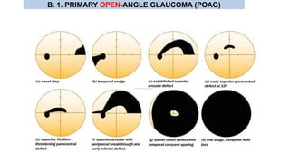 B. 1. PRIMARY OPEN-ANGLE GLAUCOMA (POAG)
 